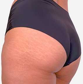 Laser stretch mark removal is safe and effective