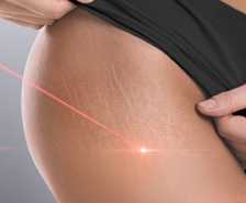 Stretch Marks Removal Treatment