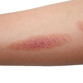 How Burn Scars Can Be Treated