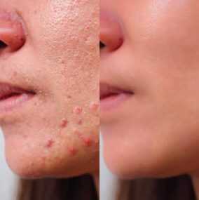 How to Avoid Acne Scarring