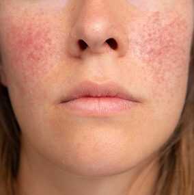 Things You Should Know When Diagnosed with Rosacea