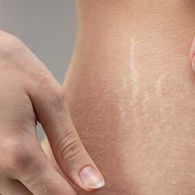 Why does the skin scar?