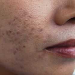 Explaining Pigmentation – Preventions and Treatments