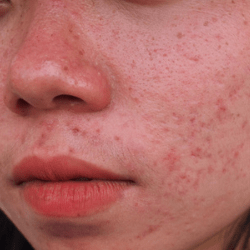 Treatments to Consider if You Have Active Acne