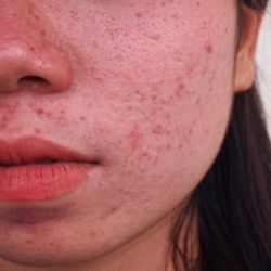 a woman with acne and acne scars on her cheek