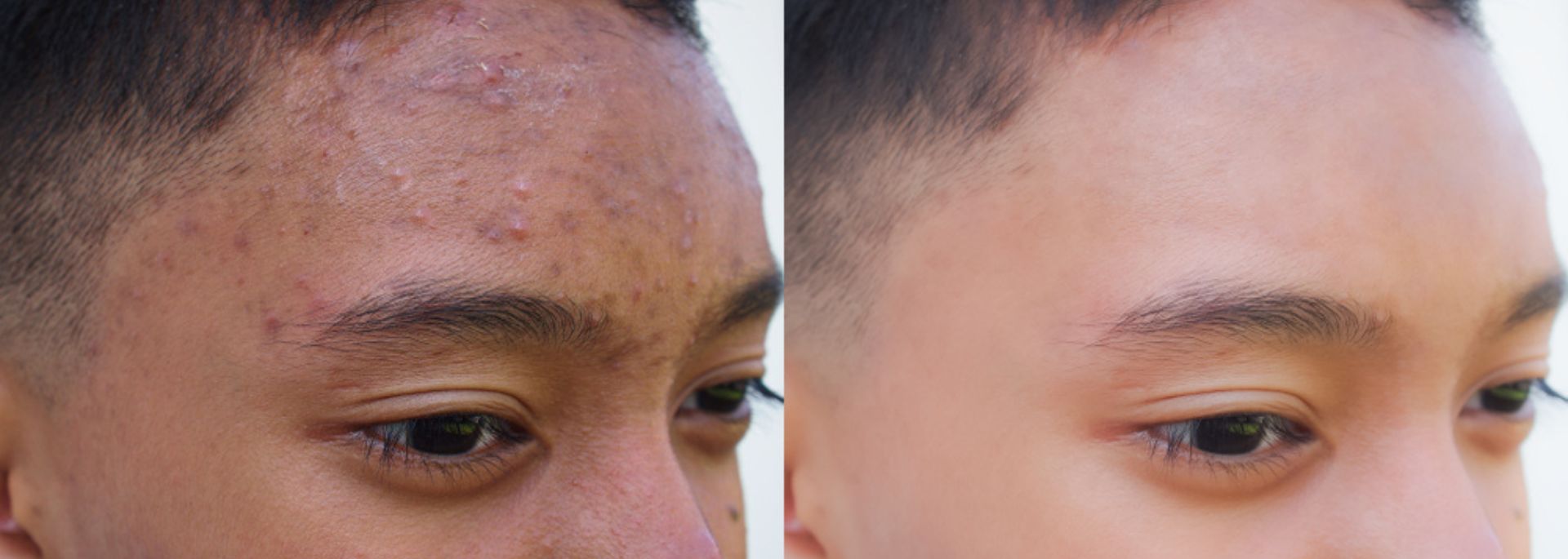 2 pictures of the same man, one picture has acne and the other has clear skin