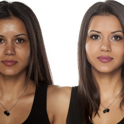 3 Ways We Treat Hyperpigmentation