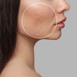 Pigmentation and acne scars