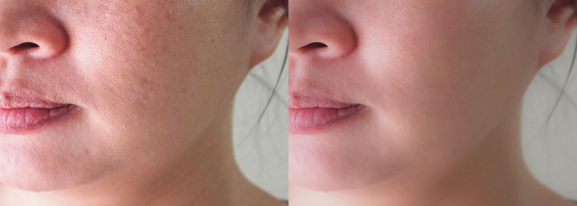 Seeing results from acne scar treatment - Side by side comparison