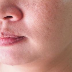 Seeing results from acne scar treatment