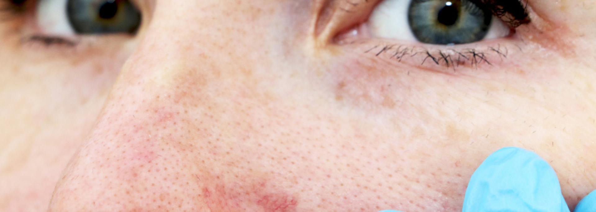 Close up shot of a women with spider veins around her nose - spider vein therapy - thread vein removal