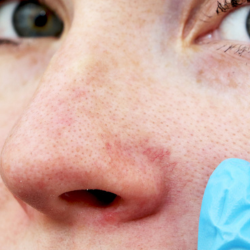 Close up shot of a women with spider veins around her nose - spider vein therapy - thread vein removal