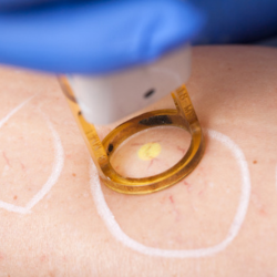 What You Need to Know if You’re Considering Thread Vein Removal
