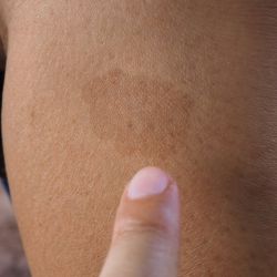 Everything You Need To Know About Cafe Au Lait Birthmarks