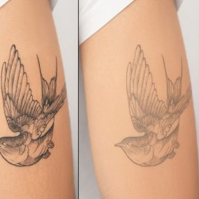 Everything You Need To Know About Laser Tattoo Removal